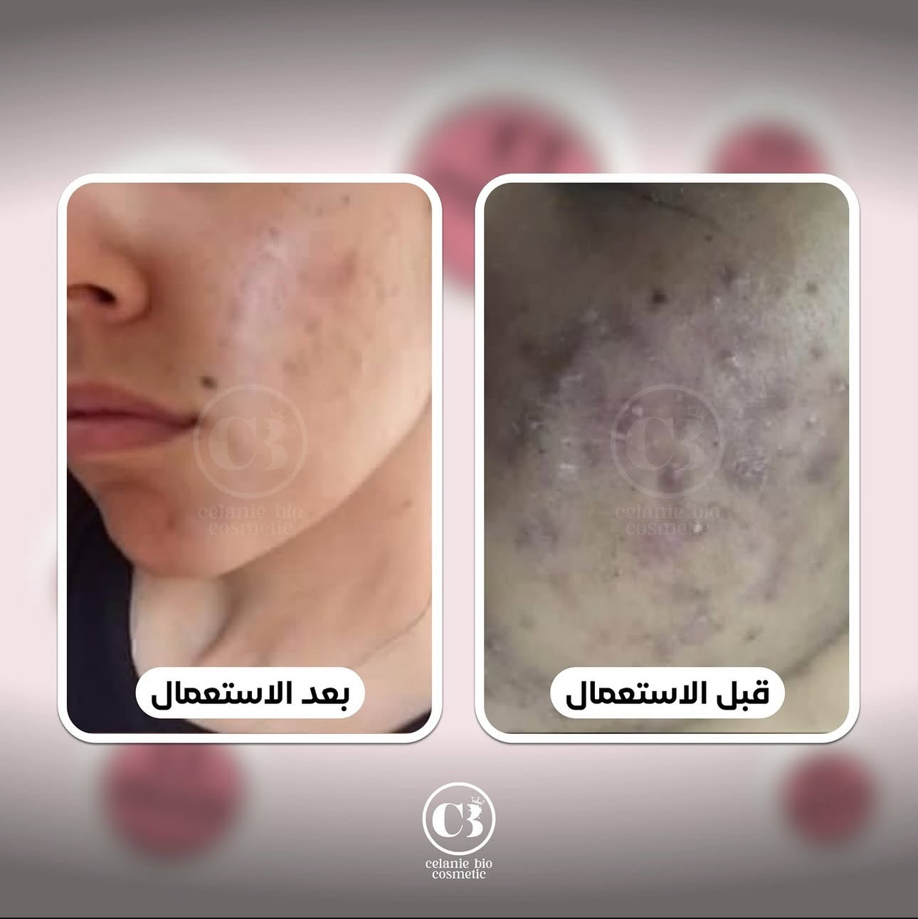 كريم ليلي مضاد للبقع الداكنة - بشرة مشرقة وخالية من العيوب ✨🌿